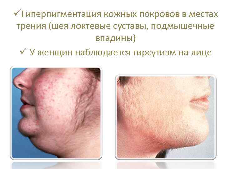 üГиперпигментация кожных покровов в местах трения (шея локтевые суставы, подмышечные впадины) ü У женщин