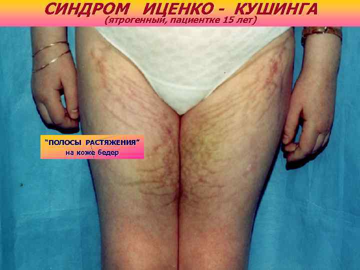 СИНДРОМ ИЦЕНКО - КУШИНГА (ятрогенный, пациентке 15 лет) “ПОЛОСЫ РАСТЯЖЕНИЯ” на коже бедер 