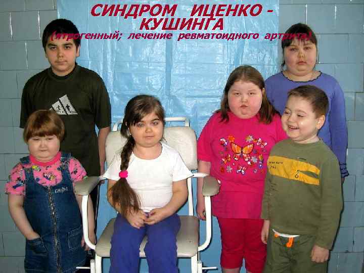 СИНДРОМ ИЦЕНКО КУШИНГА (ятрогенный; лечение ревматоидного артрита) 