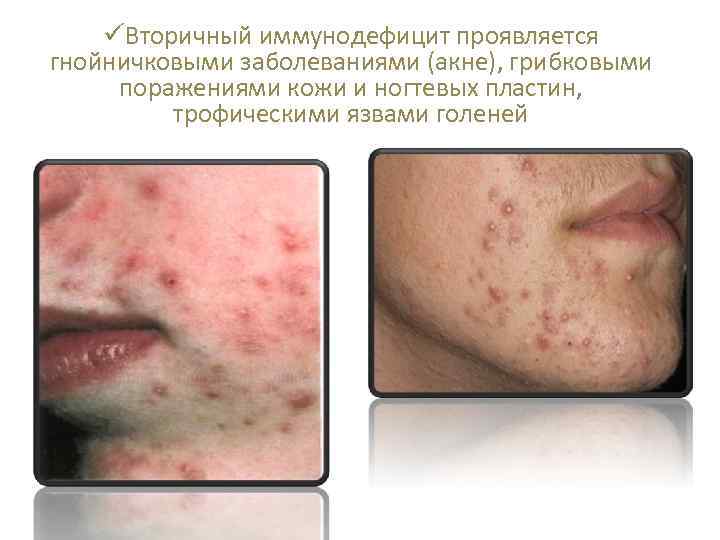 üВторичный иммунодефицит проявляется гнойничковыми заболеваниями (акне), грибковыми поражениями кожи и ногтевых пластин, трофическими язвами