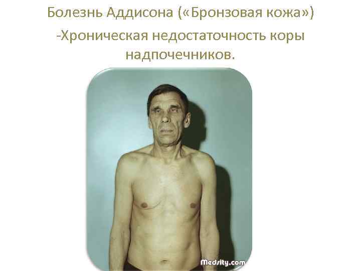 Болезнь Аддисона ( «Бронзовая кожа» ) -Хроническая недостаточность коры надпочечников. 