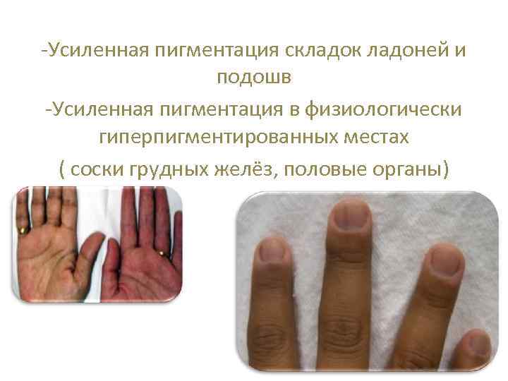 -Усиленная пигментация складок ладоней и подошв -Усиленная пигментация в физиологически гиперпигментированных местах ( соски