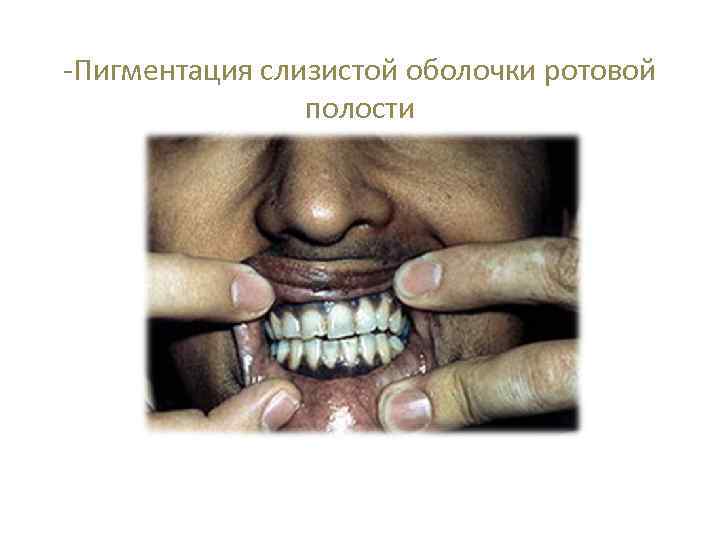 -Пигментация слизистой оболочки ротовой полости 