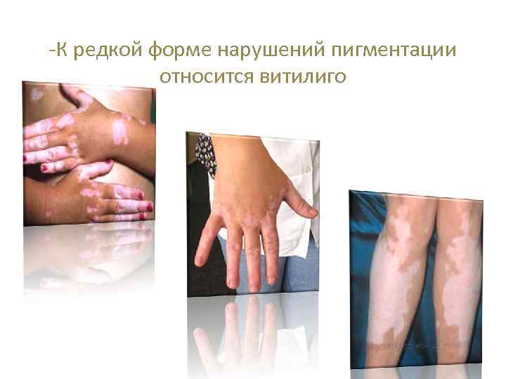 -К редкой форме нарушений пигментации относится витилиго 