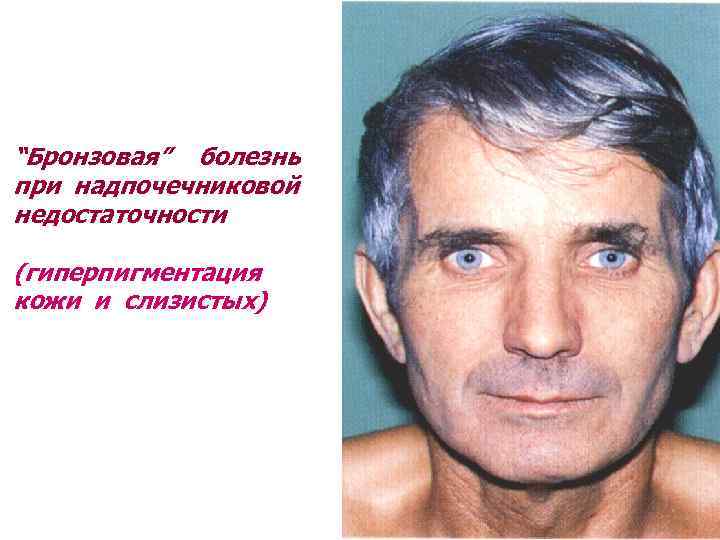 “Бронзовая” болезнь при надпочечниковой недостаточности (гиперпигментация кожи и слизистых) 