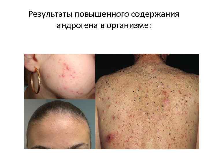 Результаты повышенного содержания андрогена в организме: 