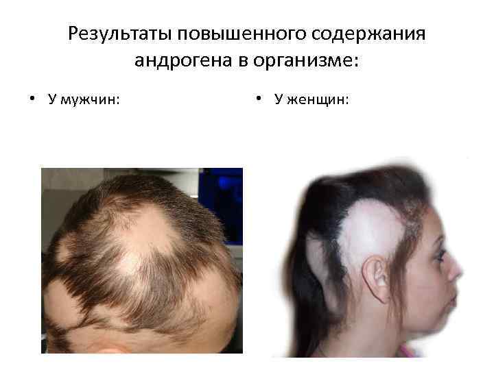 Результаты повышенного содержания андрогена в организме: • У мужчин: • У женщин: 