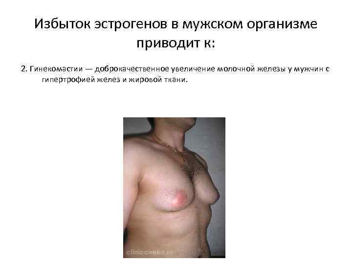 Избыток эстрогенов в мужском организме приводит к: 2. Гинекомастии — доброкачественное увеличение молочной железы