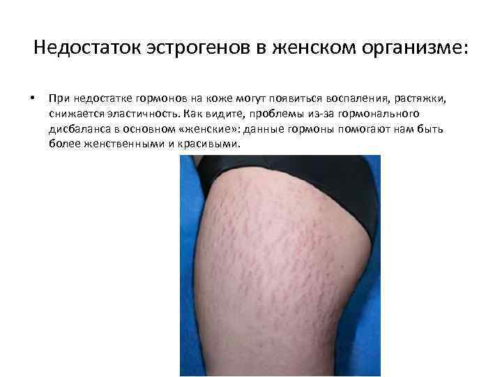 Недостаток эстрогенов в женском организме: • При недостатке гормонов на коже могут появиться воспаления,