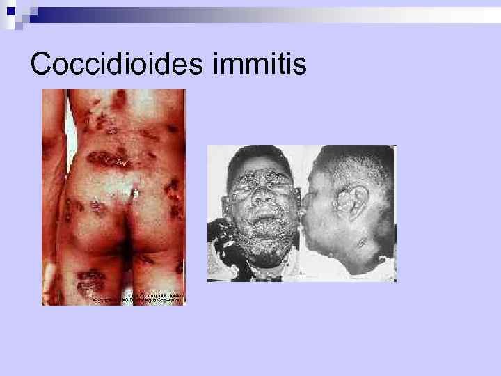 Coccidioides immitis 