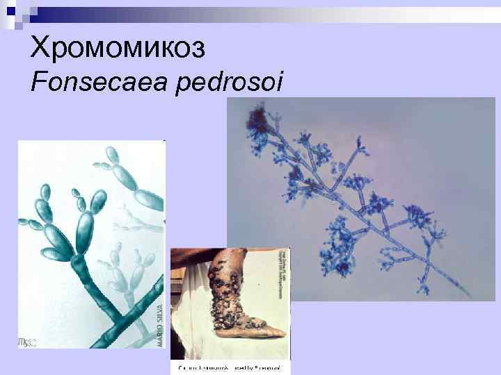 Хромомикоз Fonsecaea pedrosoi 