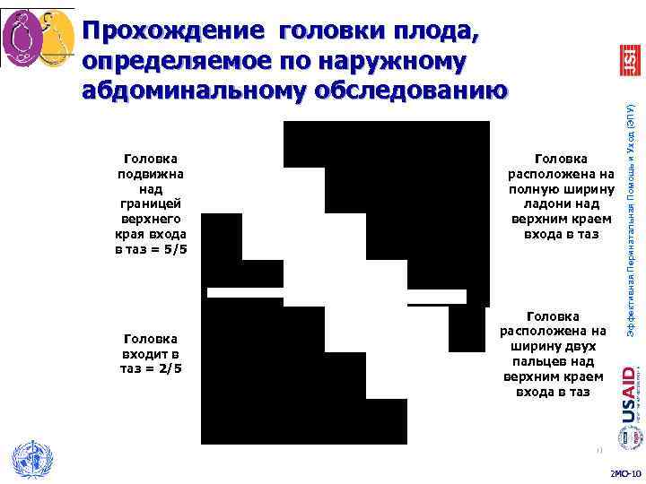 Прохождение головки плода, определяемое по наружному абдоминальному обследованию     Эффективная Перинатальная