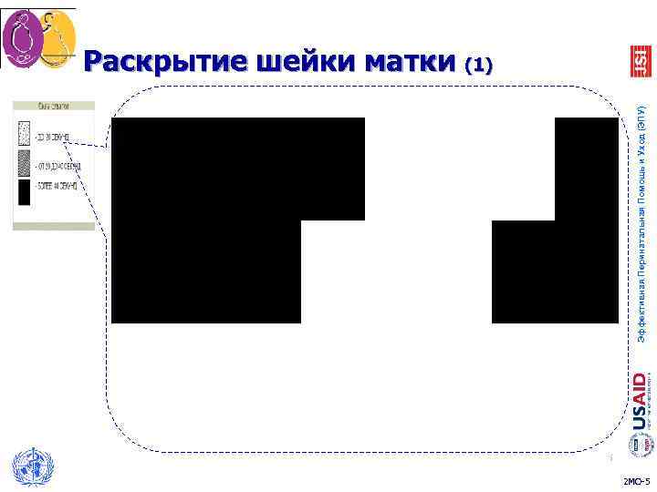      Раскрытие шейки матки (1)   5  