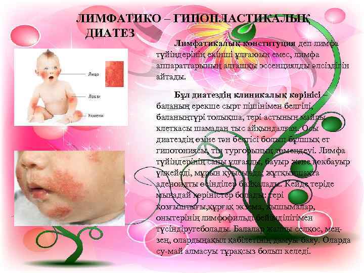 ЛИМФАТИКО – ГИПОПЛАСТИКАЛЫҚ ДИАТЕЗ   Лимфатикалық конституция деп лимфа   түйіндерінің екінші