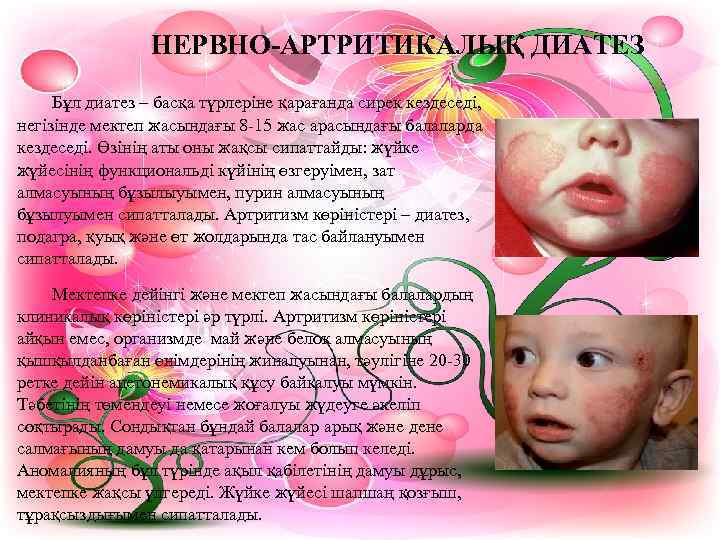    НЕРВНО-АРТРИТИКАЛЫҚ ДИАТЕЗ Бұл диатез – басқа түрлеріне қарағанда сирек кездеседі, негізінде