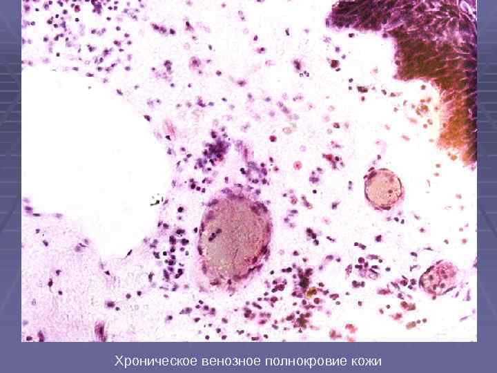 Хроническое венозное полнокровие кожи 