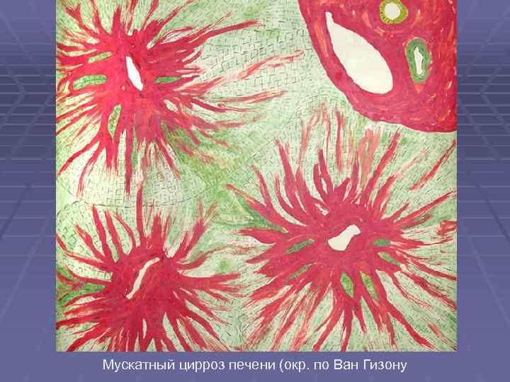 Мускатный цирроз печени (окр. по Ван Гизону 