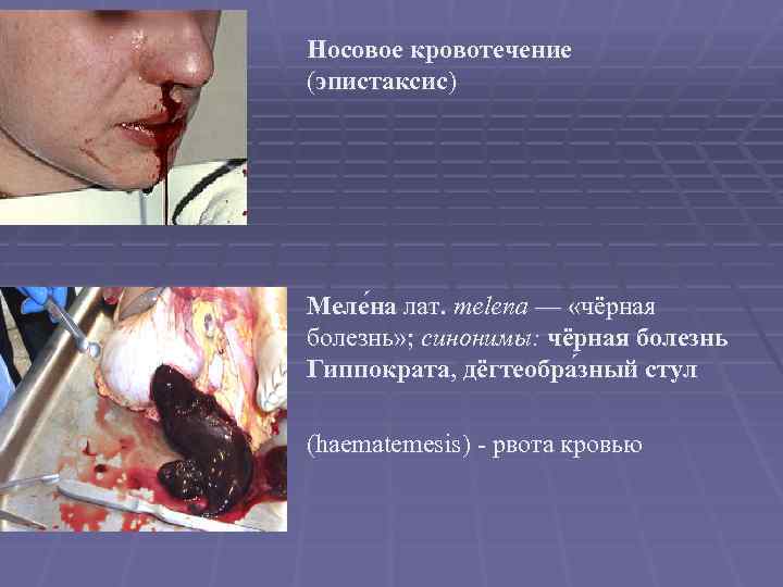 Носовое кровотечение (эпистаксис) Меле на лат. melena — «чёрная болезнь» ; синонимы: чёрная болезнь