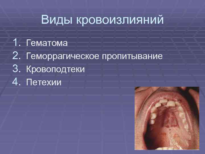 Виды кровоизлияний 1. 2. 3. 4. Гематома Геморрагическое пропитывание Кровоподтеки Петехии 