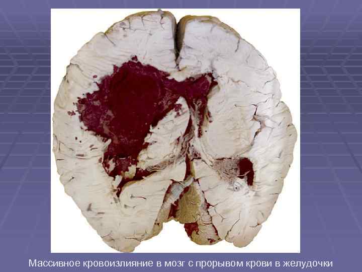 Массивное кровоизлияние в мозг с прорывом крови в желудочки 