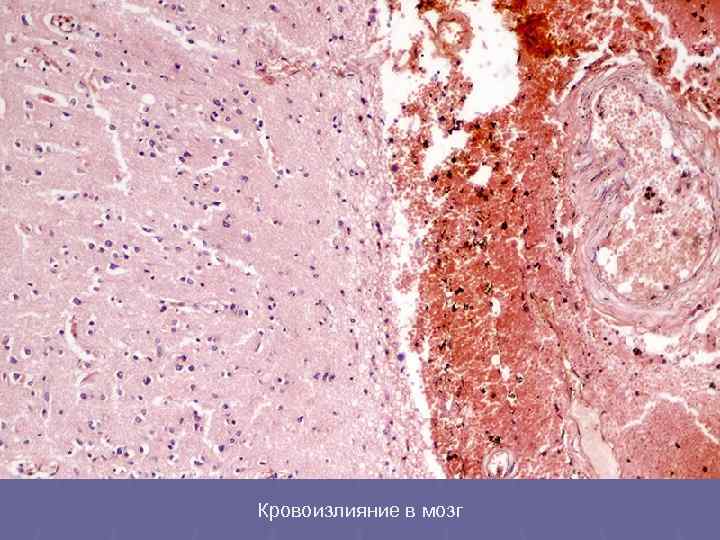 Кровоизлияние в мозг 