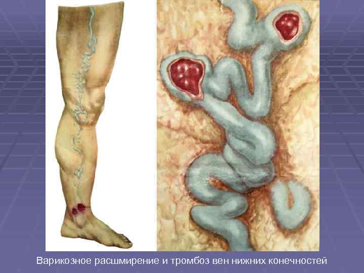 Варикозное расшмирение и тромбоз вен нижних конечностей 