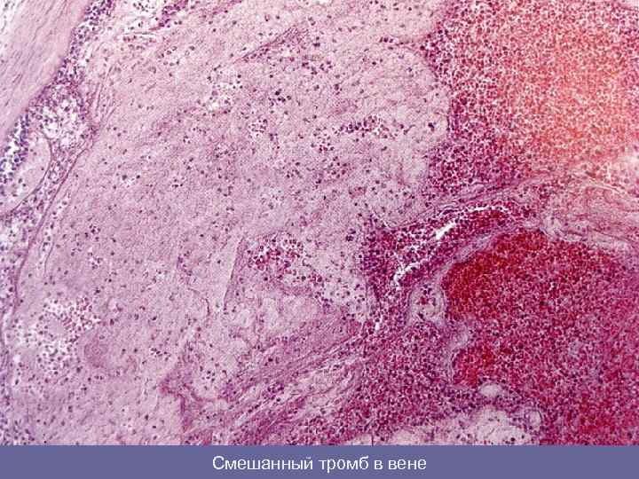 Смешанный тромб в вене 
