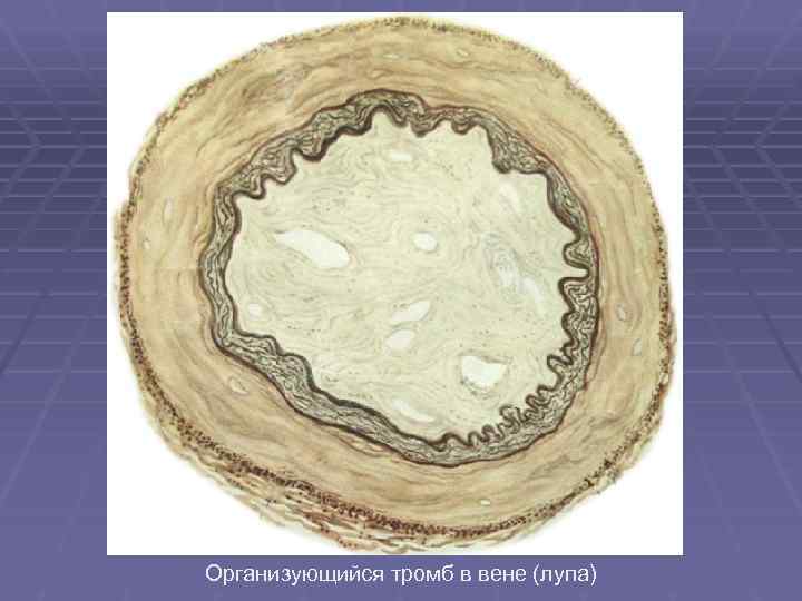 Организующийся тромб в вене (лупа) 