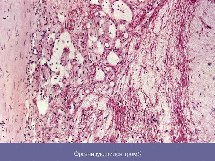 Организующийся тромб 