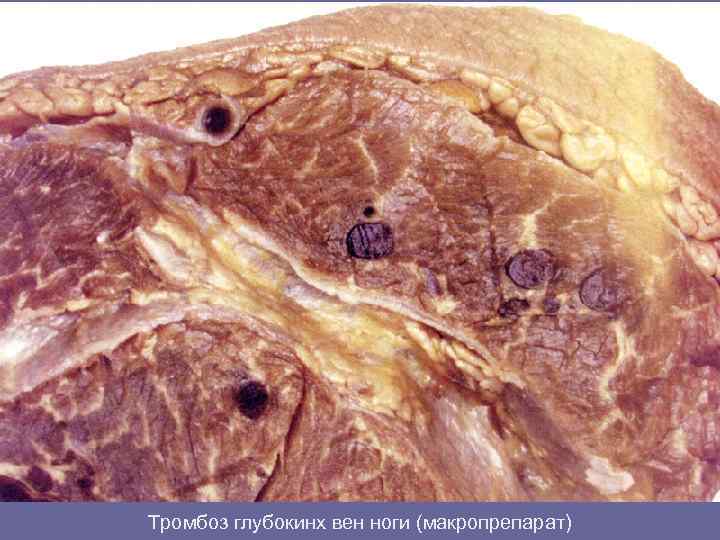 Тромбоз глубокинх вен ноги (макропрепарат) 