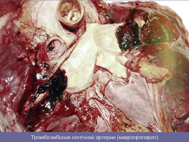 Тромбоэмболия легочной артерии (макропрепарат) 