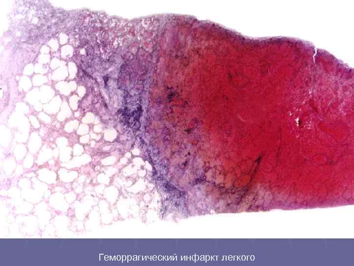 Геморрагический инфаркт легкого 