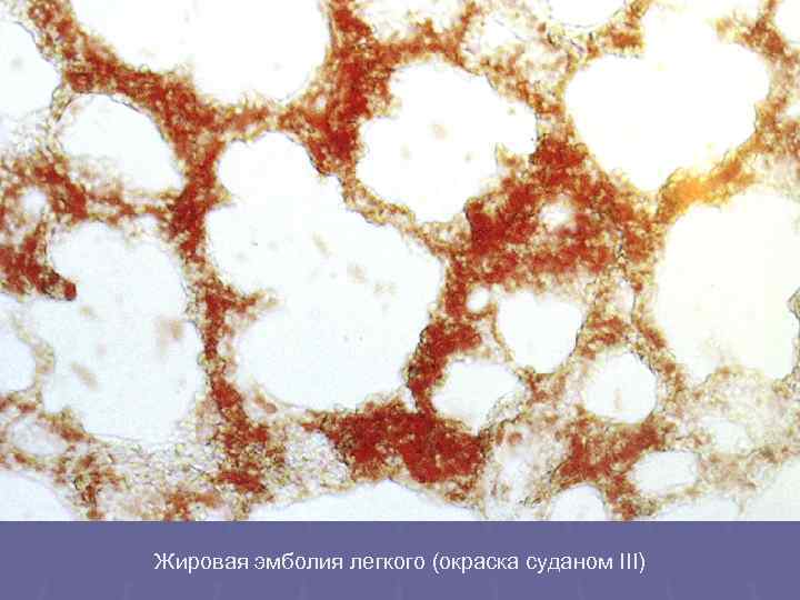 Жировая эмболия легкого (окраска суданом III) 