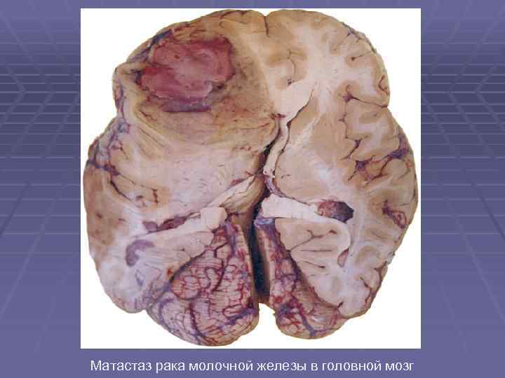 Матастаз рака молочной железы в головной мозг 