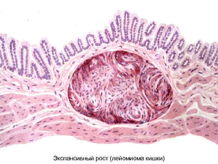 Экспансивный рост (лейомиома кишки) 