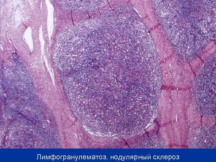 Лимфогранулематоз, нодулярный склероз 