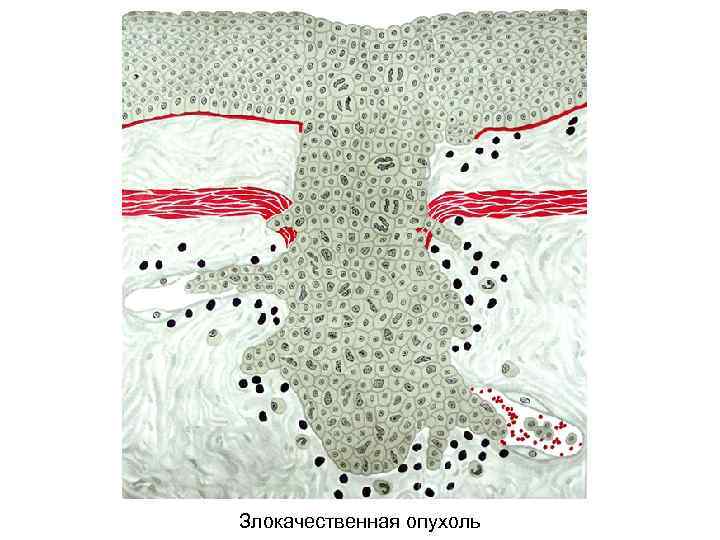 Злокачественная опухоль 