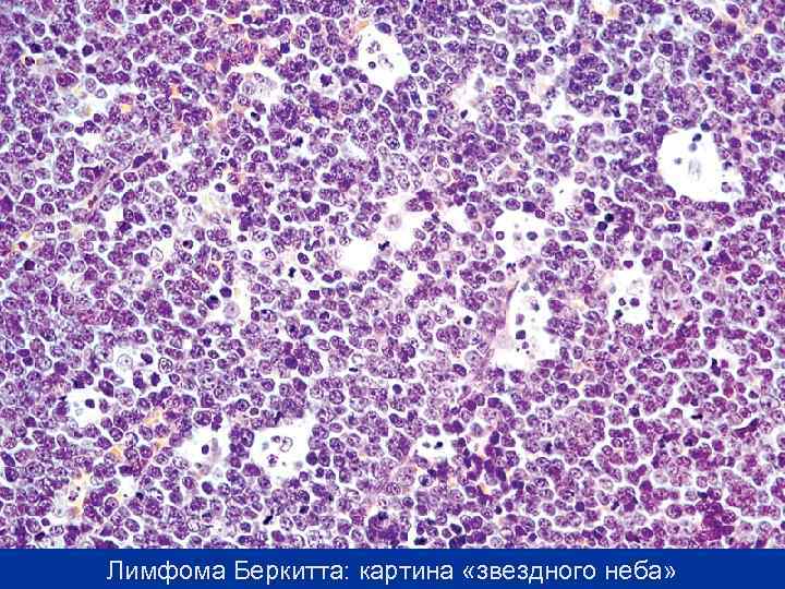 Лимфома Беркитта: картина «звездного неба» 