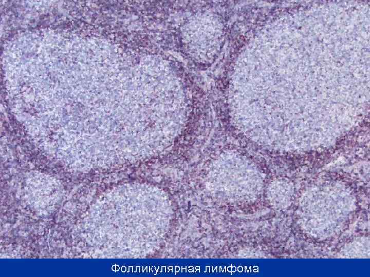 Фолликулярная лимфома 
