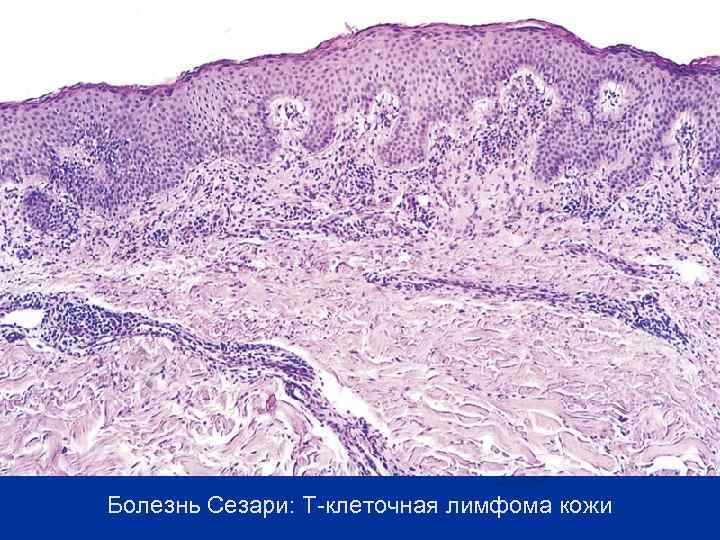 Болезнь Сезари: Т-клеточная лимфома кожи 