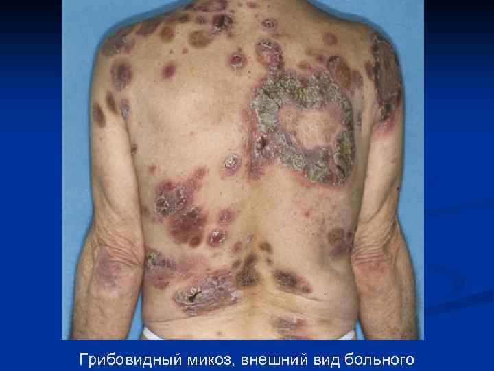 Грибовидный микоз, внешний вид больного 