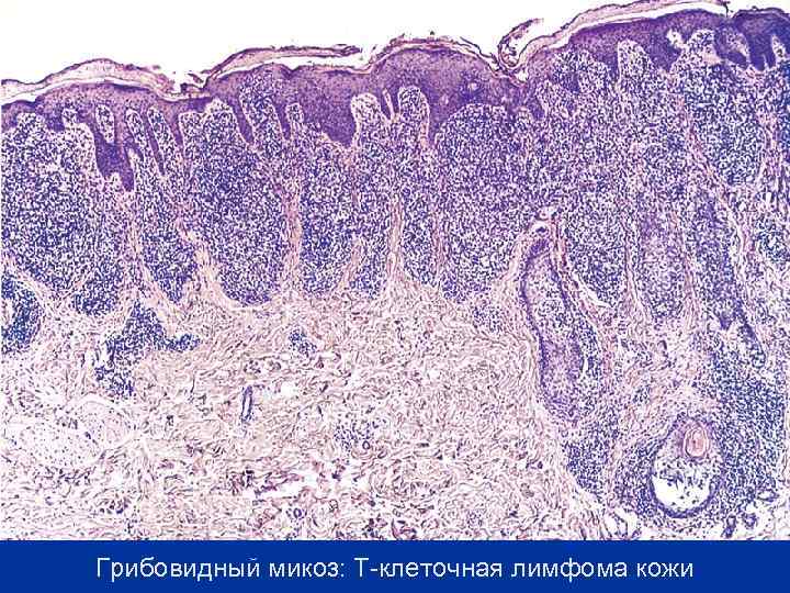 Грибовидный микоз: Т-клеточная лимфома кожи 