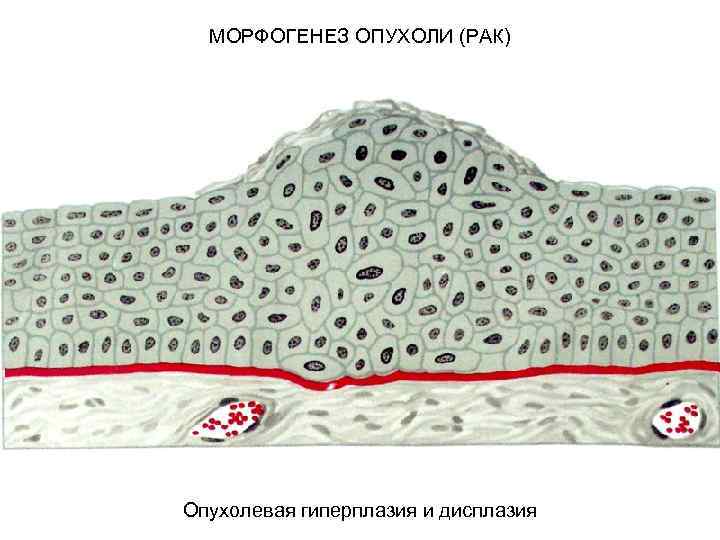 МОРФОГЕНЕЗ ОПУХОЛИ (РАК) Опухолевая гиперплазия и дисплазия 