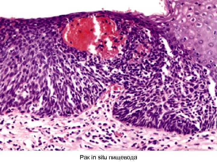 Рак in situ пищевода 