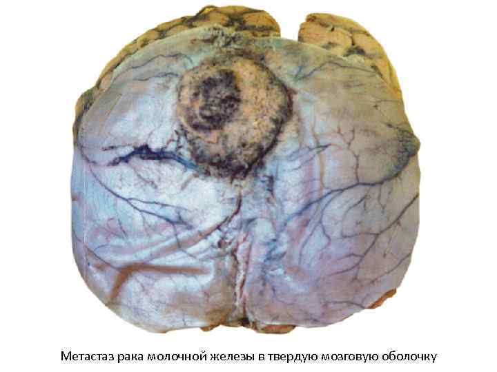 Метастаз рака молочной железы в твердую мозговую оболочку 