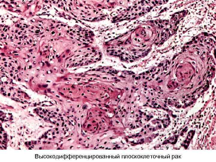 Высокодифференцированный плоскоклеточный рак 
