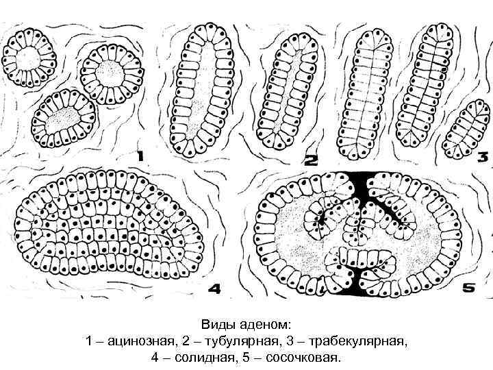 Виды аденом: 1 – ацинозная, 2 – тубулярная, 3 – трабекулярная, 4 – солидная,