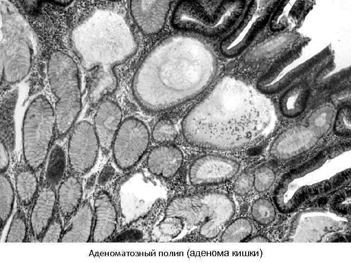 Аденоматозный полип (аденома кишки) 
