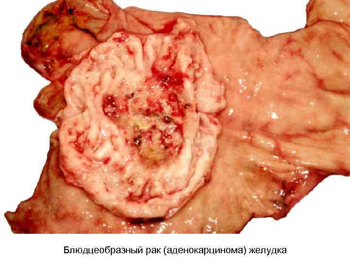 Блюдцеобразный рак (аденокарцинома) желудка 