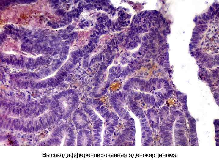 Высокодифференцированная аденокарцинома 